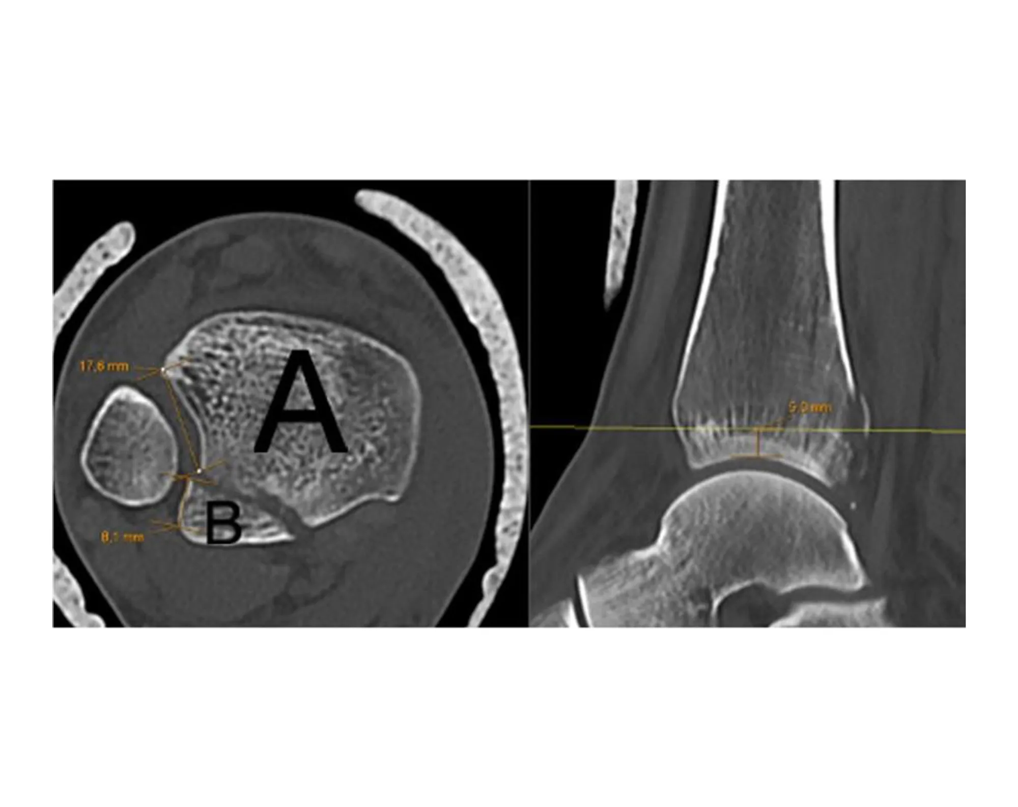 Måling notchinvolovering av posterolateralt fragment 5 mm over tibia plafonden.