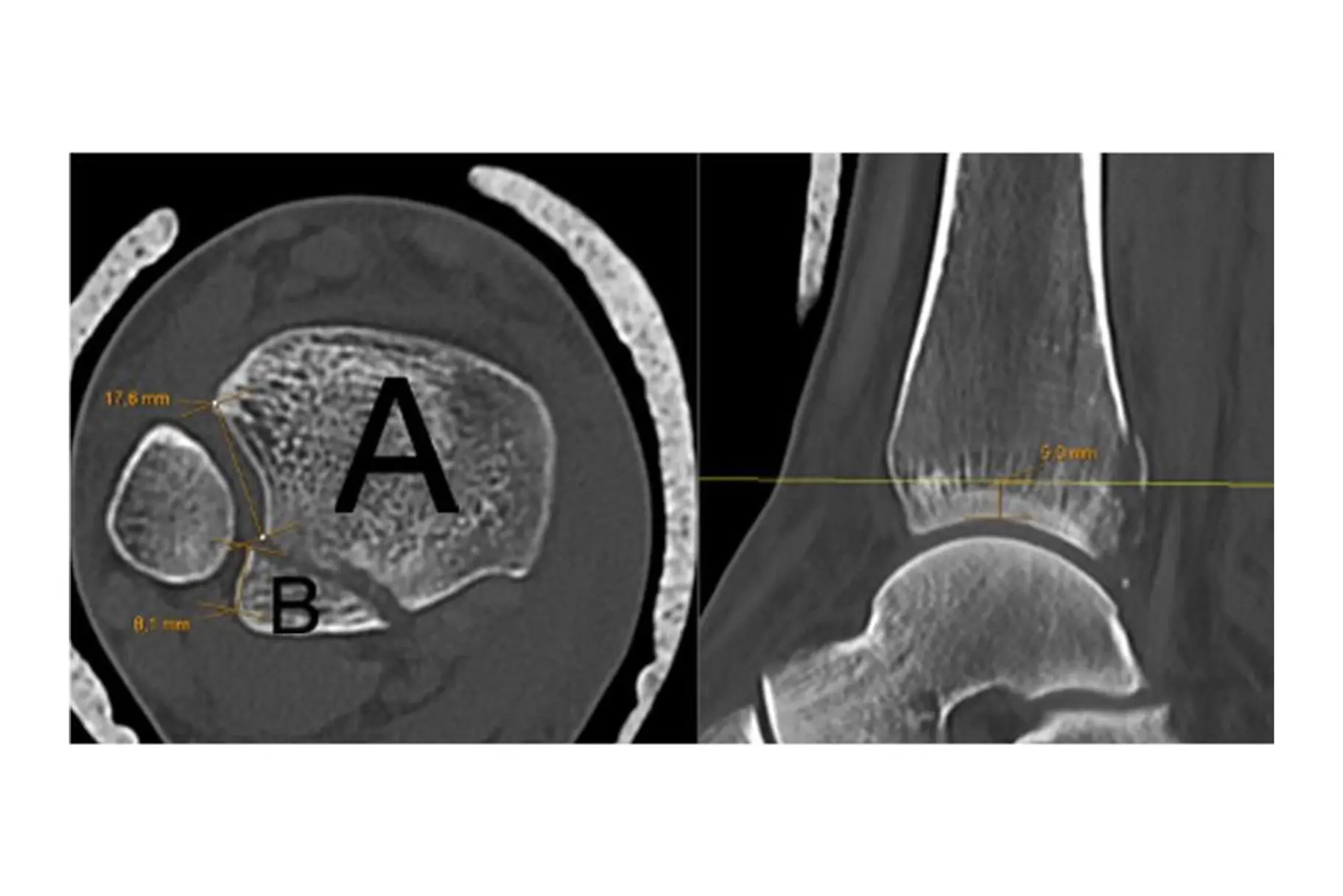 Måling notchinvolovering av posterolateralt fragment 5 mm over tibia plafonden.