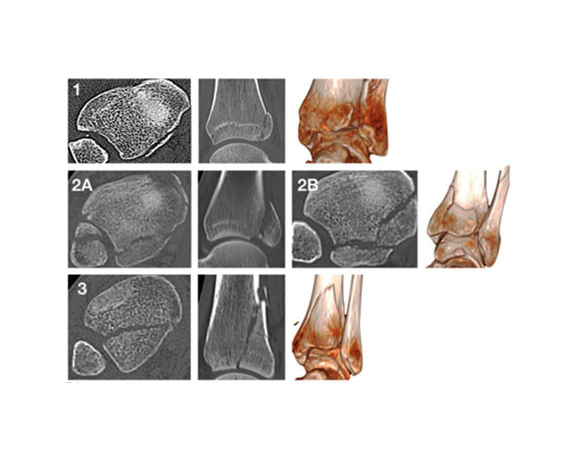 Illustrasjoner av ulike typer posterolateralt fragment.