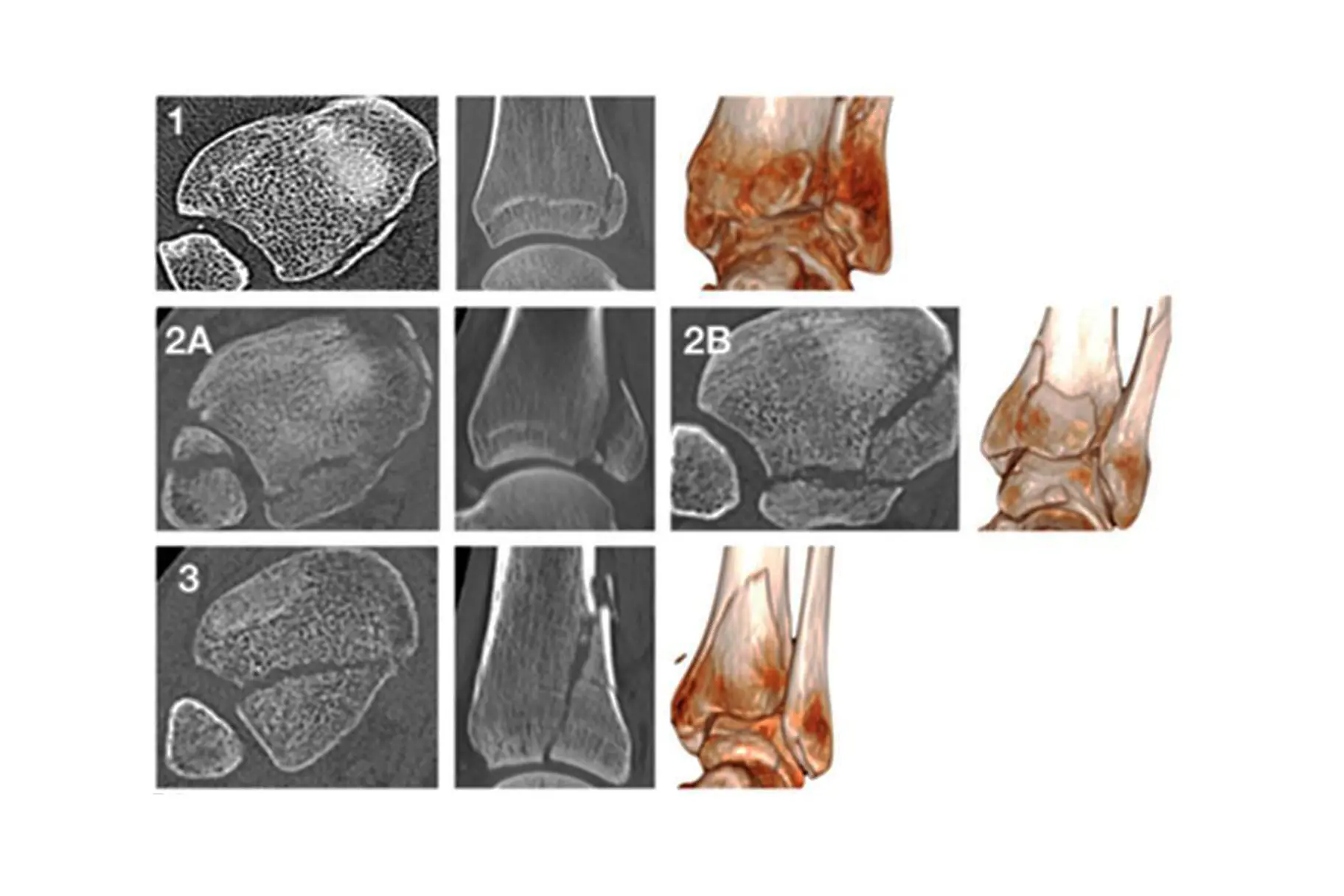 Illustrasjoner av ulike typer posterolateralt fragment.