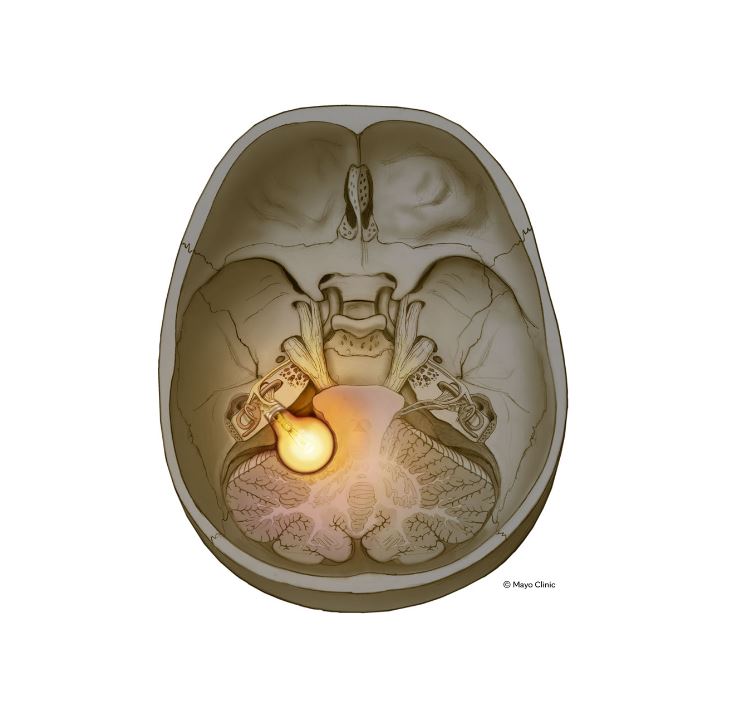 Tverrsnitt av kranie og hjerne med tent lyspære inni.