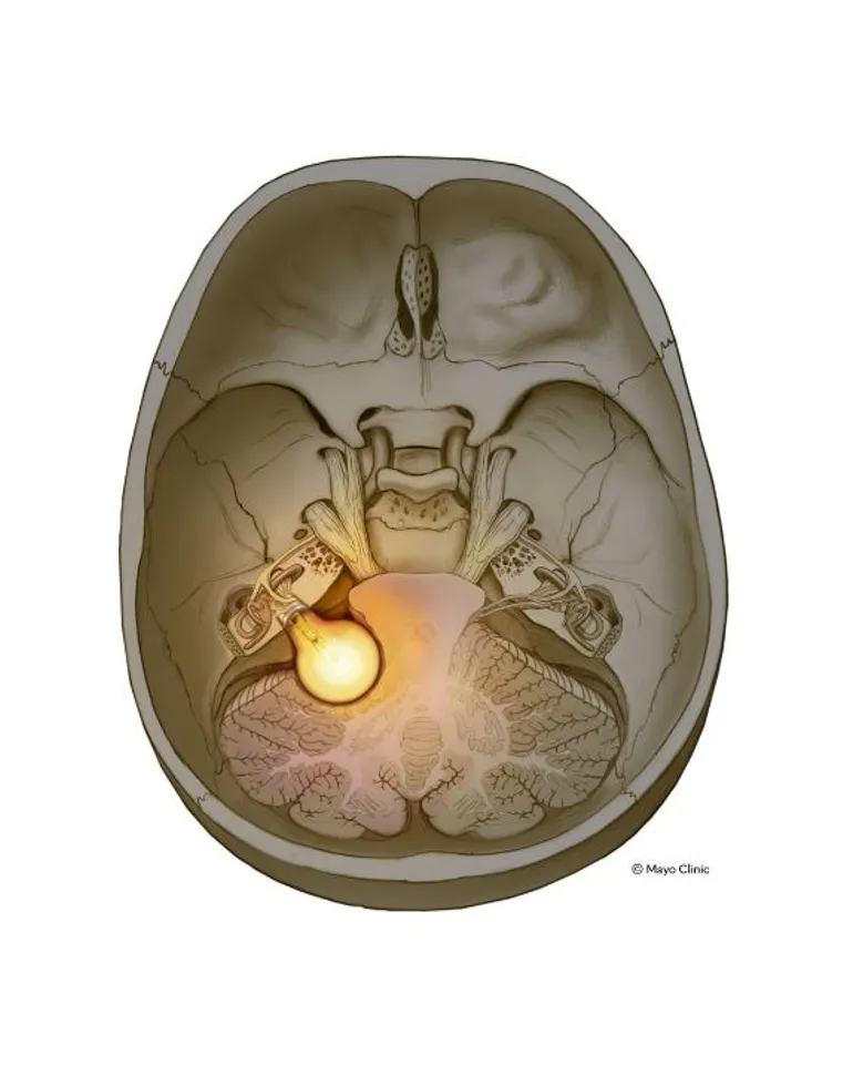 Tverrsnitt av kranie og hjerne med tent lyspære inni.