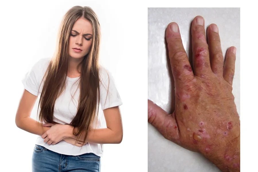 To bilder, ett med en person som har vondt i magen, og ett med en hånd med blemmer, sår og arr.