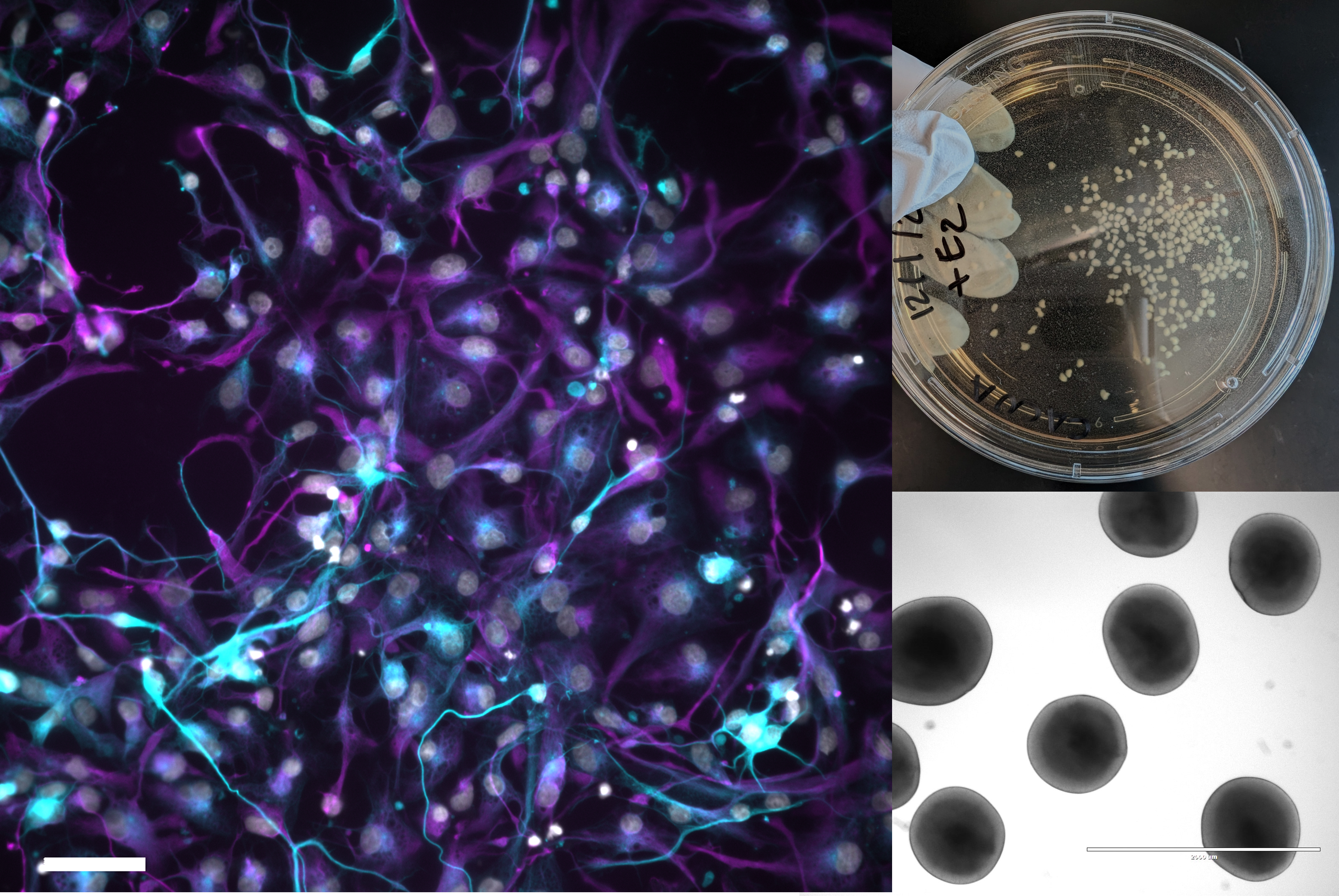 Differentiation of neuronal progenitor cells into neurons and glia (left), forebrain organoids in culture (upper right) and a brightfield image of brain organoids in culture (lower left).