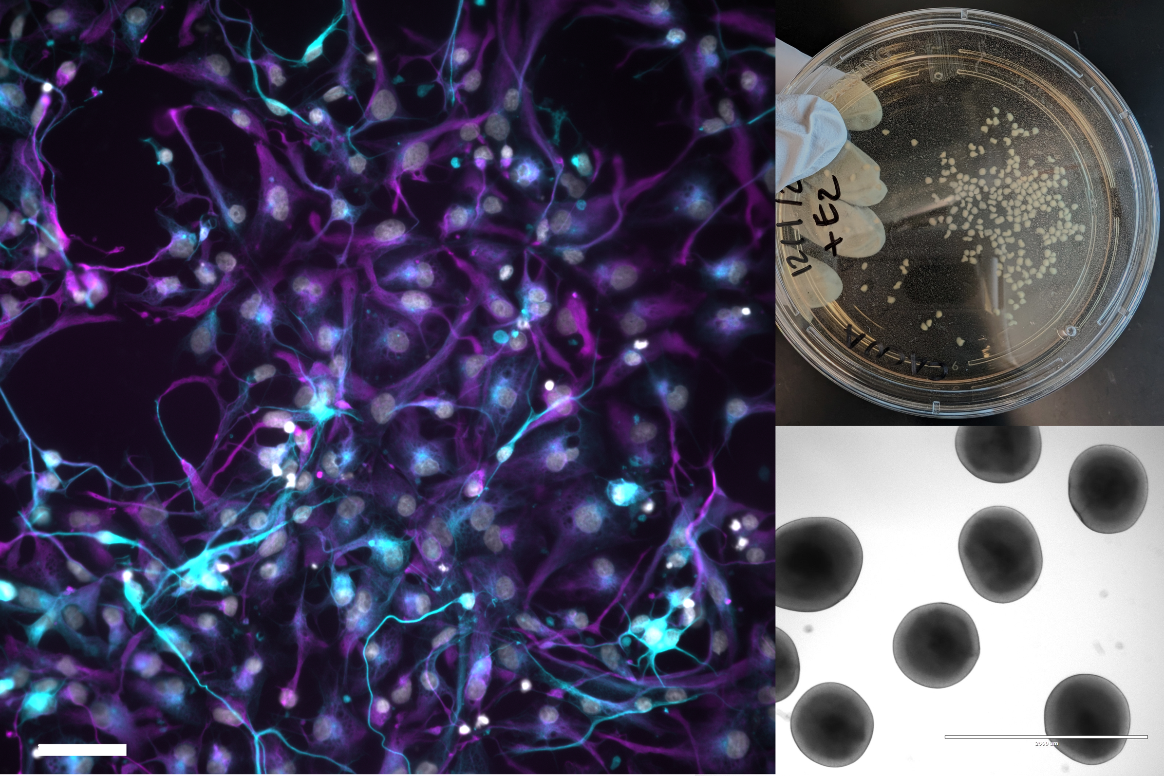 Differentiation of neuronal progenitor cells into neurons and glia (left), forebrain organoids in culture (upper right) and a brightfield image of brain organoids in culture (lower left).