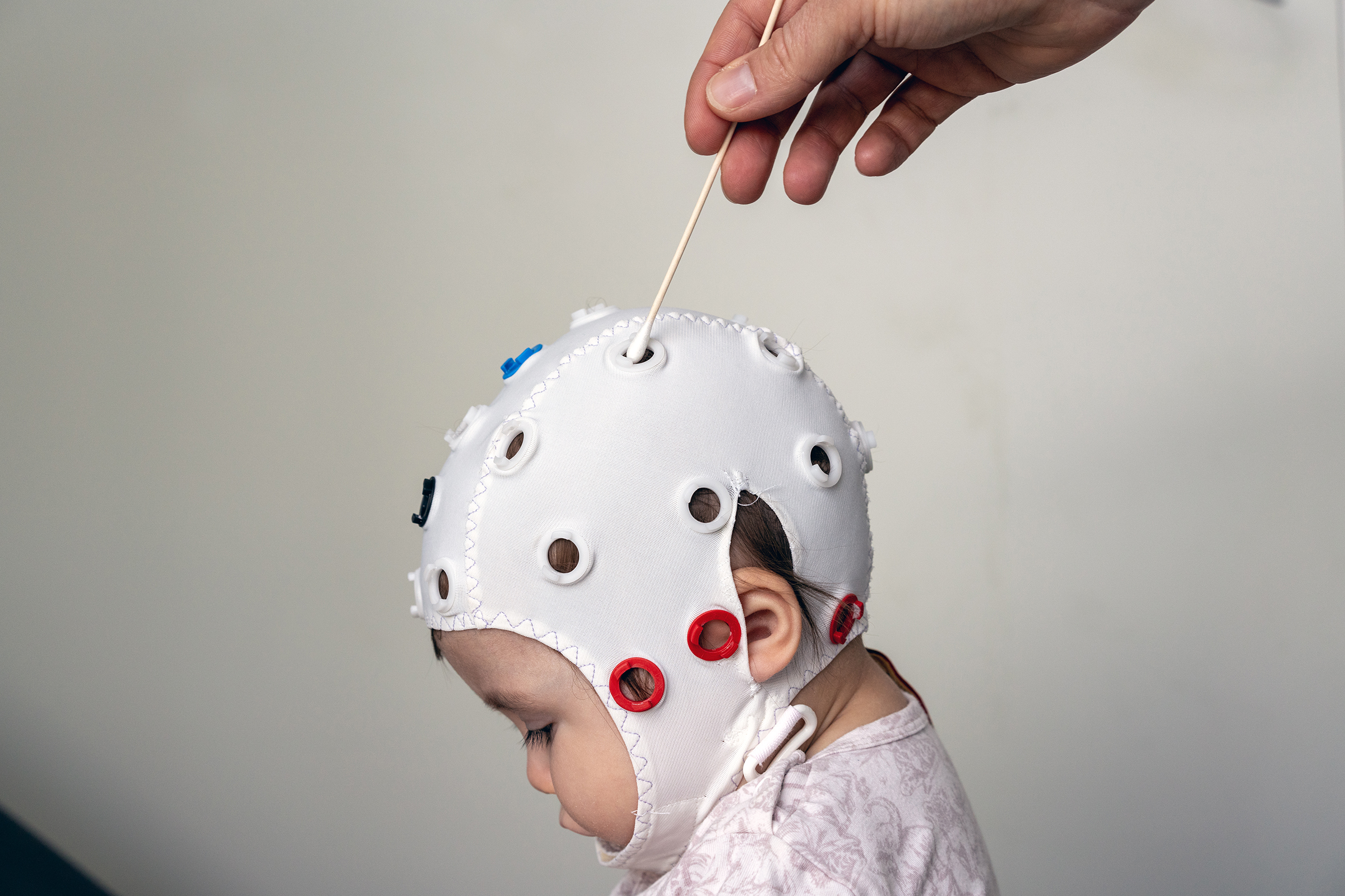 Et barn med EKG-hette som får krem i hullene på hetten