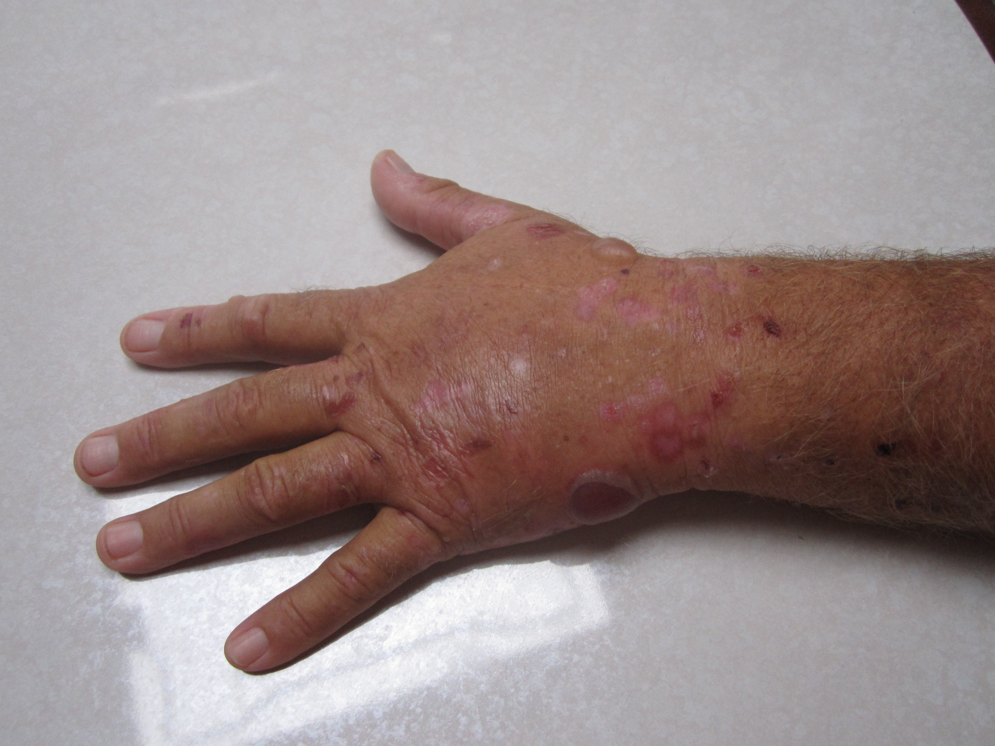 HJånd med blemmer, sår og arr