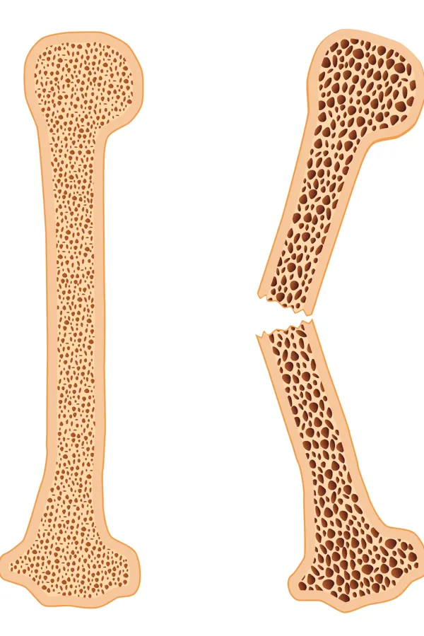 Knokler med benskjørhet