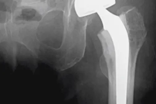 Røntgenbilde - hoftebrudd behandlet med delprotese.