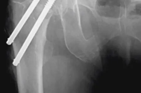 Røntgenbilde hoftebrudd operert med to skruer.