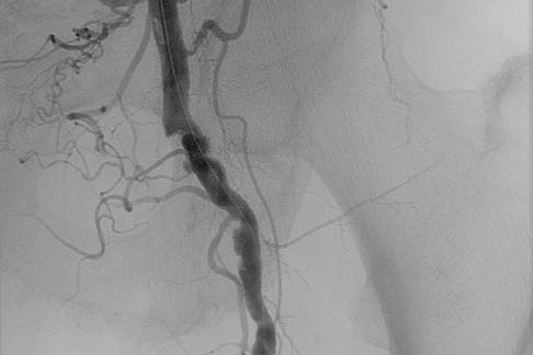 Etter actilyse og PTA. Røntgen