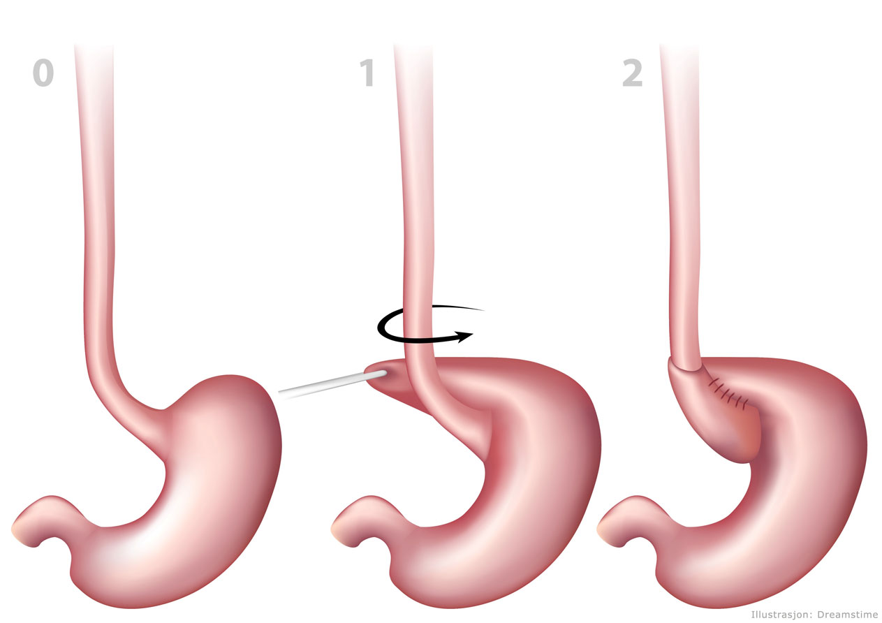 Grafisk framstilling av kirurgisk inngrep Nissens fundusplastikk. Illustrasjon