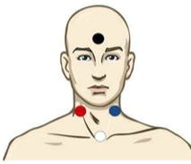 Tegning av person med prikker i ulike farger som markerer hvor elektrodene festes i pannen, og halsen. Illustrasjon