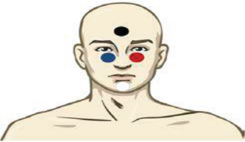 Tegning av person med fire prikker i ulik farge plassert i pannen, på hver side av nesen og på haken. Illustrasjon