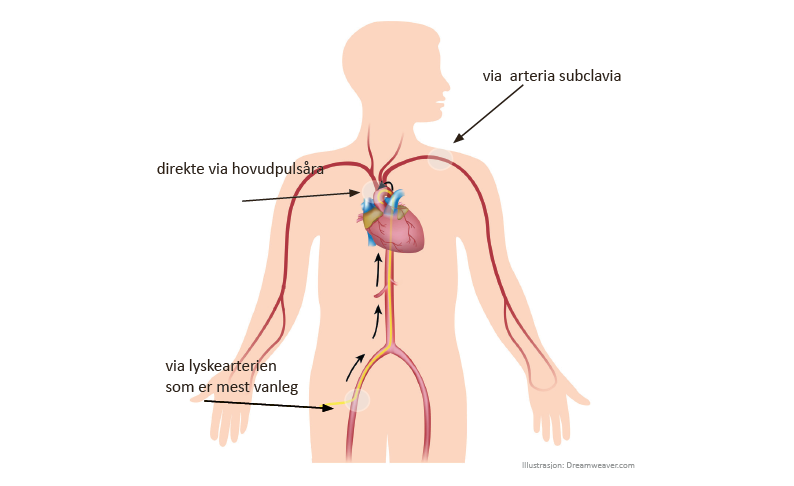 innstikkssted kateter