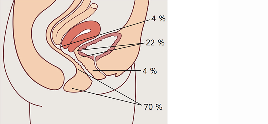 Tegningen viser hvor i underlivet fistler oppstår og prosentvis fordeling.