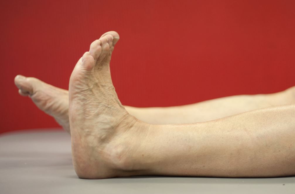 Ankelledd bøyd oppover. Foto