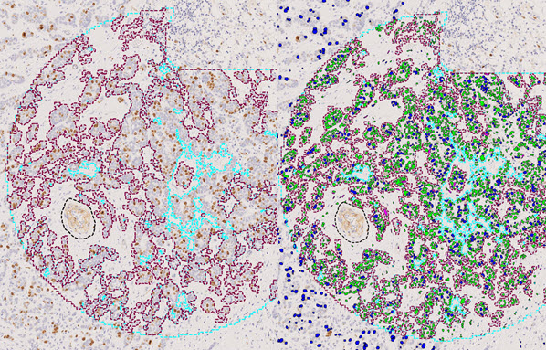 Proliferation in breast cancer