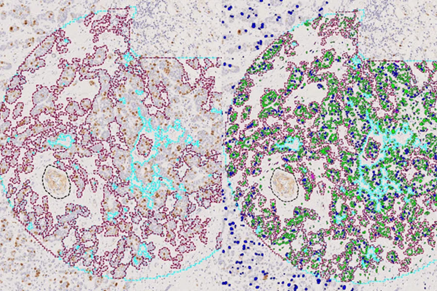 Proliferation in breast cancer