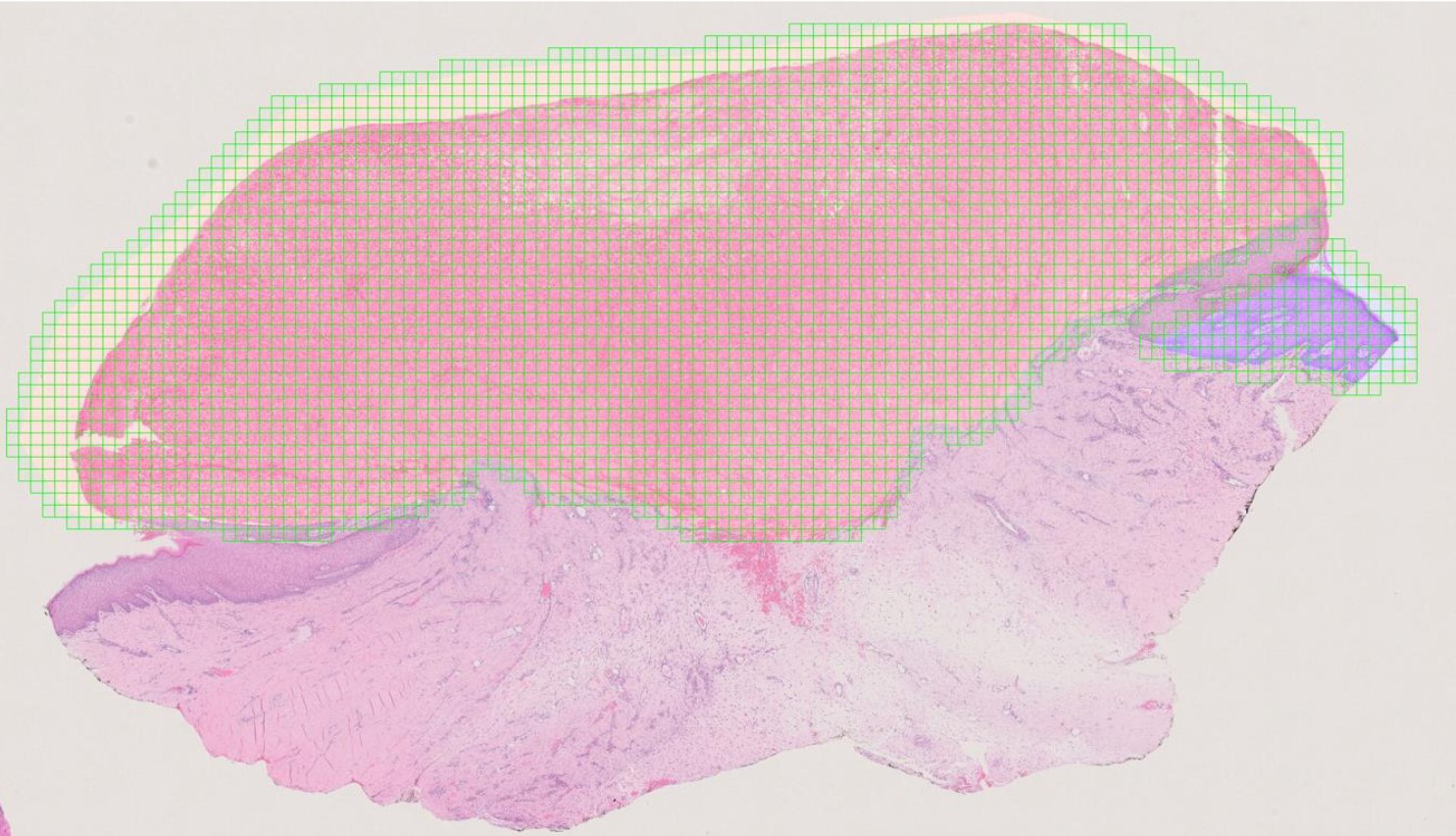 Work package 5: Automatic classification of skin lesions