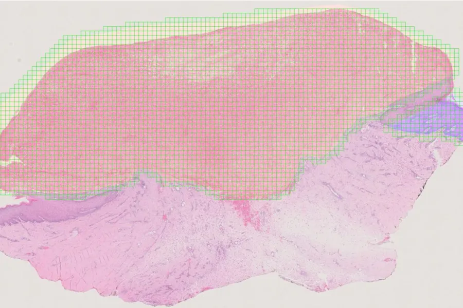 Work package 5: Automatic classification of skin lesions