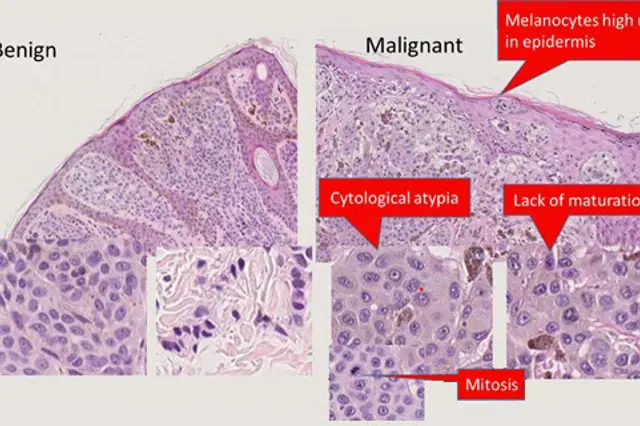 Benign malignant slide image