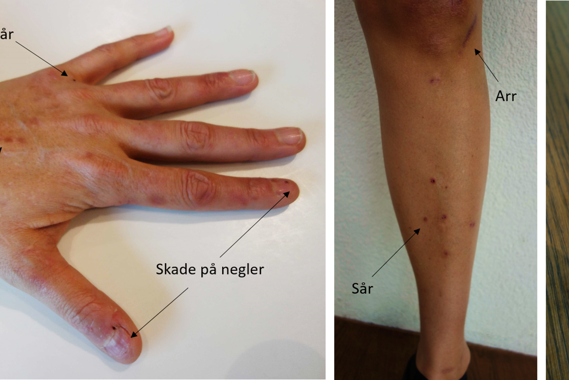 Symptomer på hånd, legg og vrist