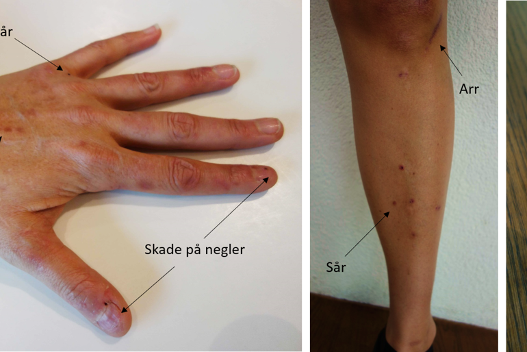 Symptomer på hånd, legg og vrist