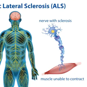 Tegning av friske nerveceller som får musklene til å trekke seg sammen, og syke nerveceller som ikke klarer jobben.