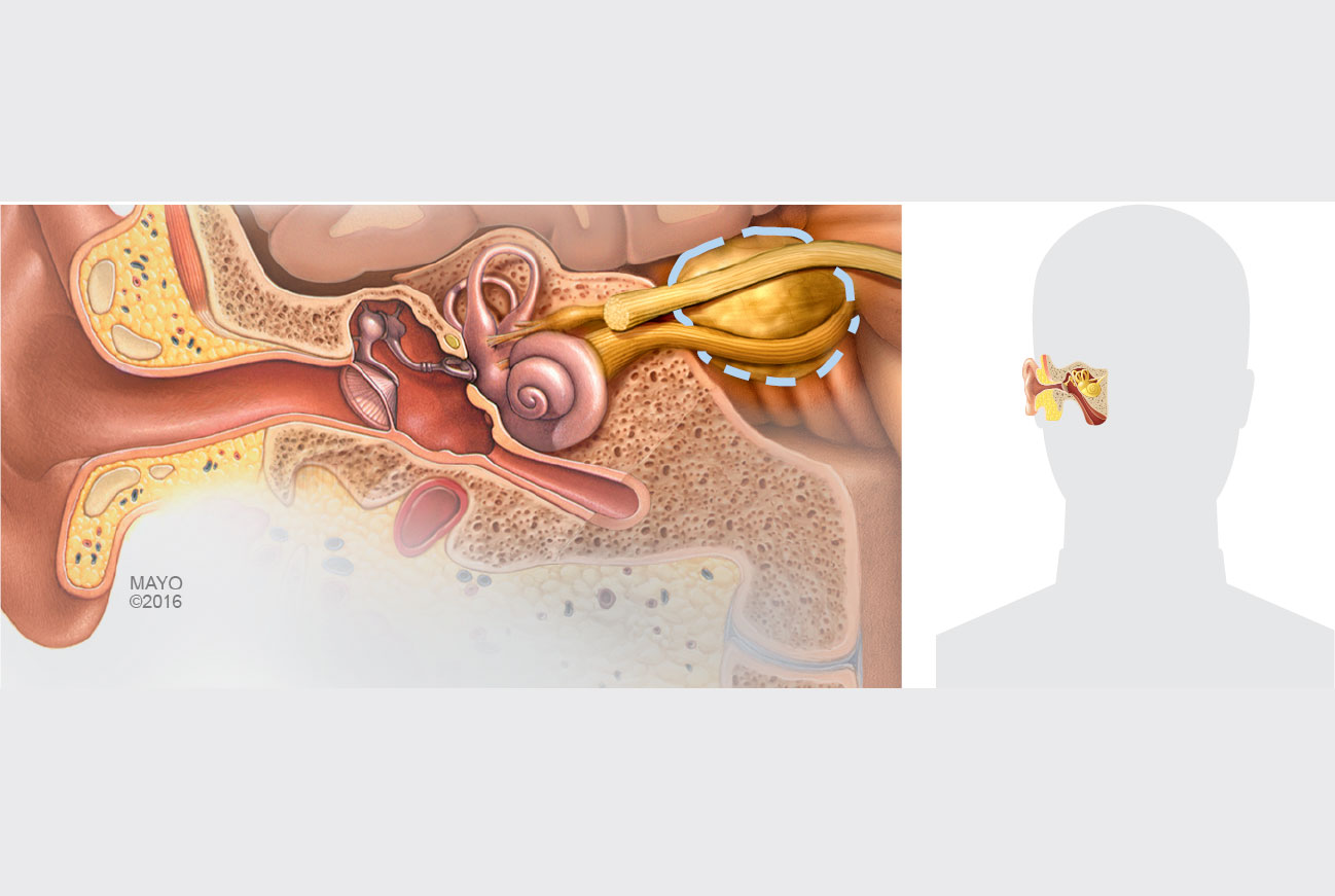 Modell som viser svulst på balansegangen, tverrsnitt av øregang, og plassering i hodet på menneskesilhuett.