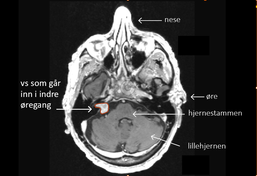 MR bilde av pasient med tekstforklaring, svulst på balansenerven, indre øregang, hjernestamme, lillehjernen, øre, nese.