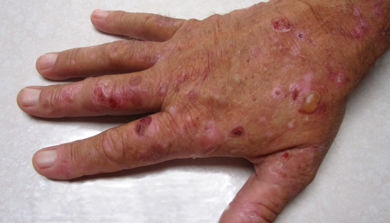 Ein person si hand med sår og blemmer.