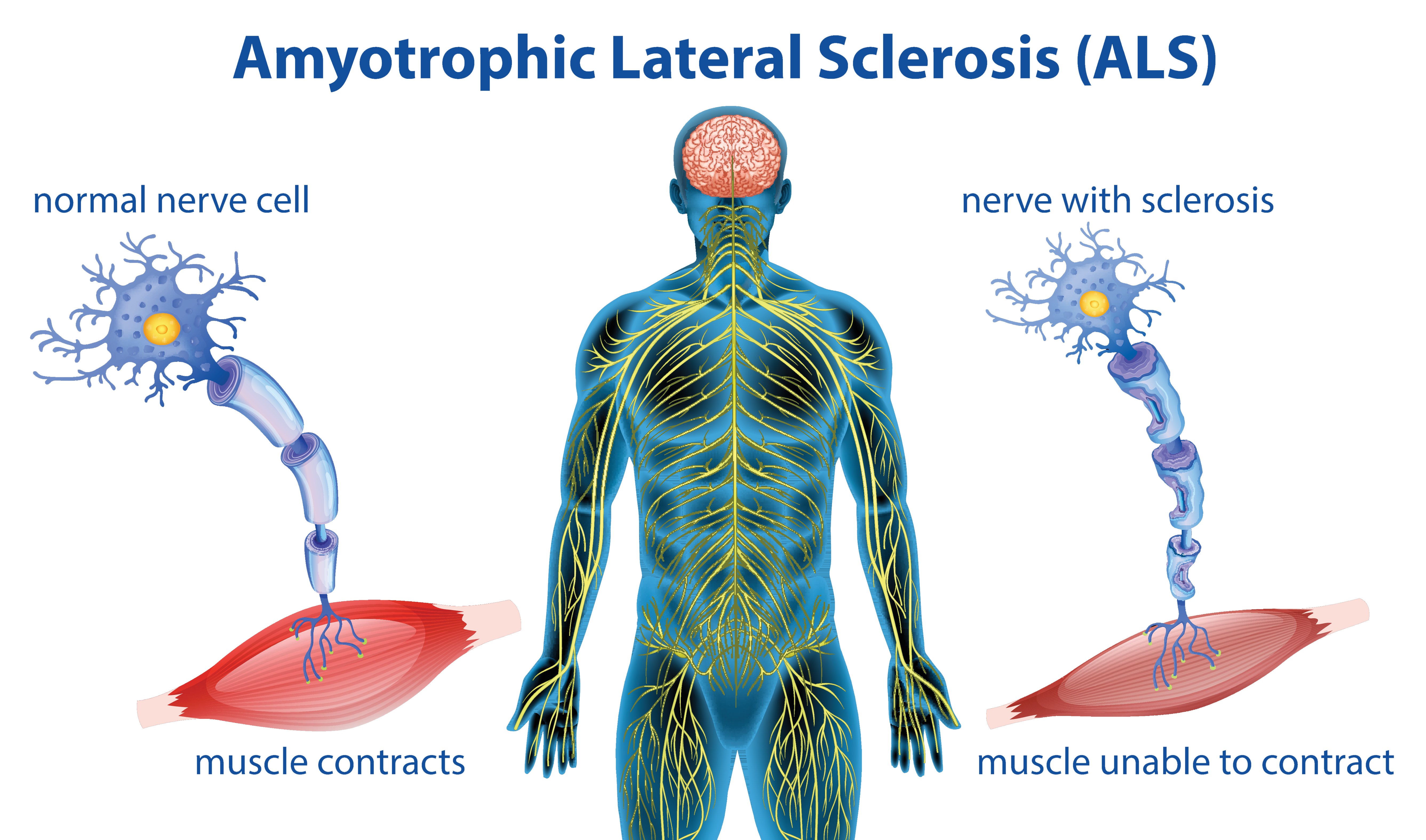 Illustration of a body and damaged nerve cells that are unable to contract.