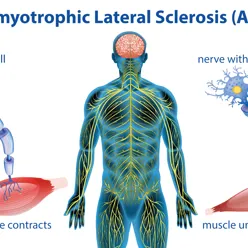 Illustration of a body and damaged nerve cells that are unable to contract.