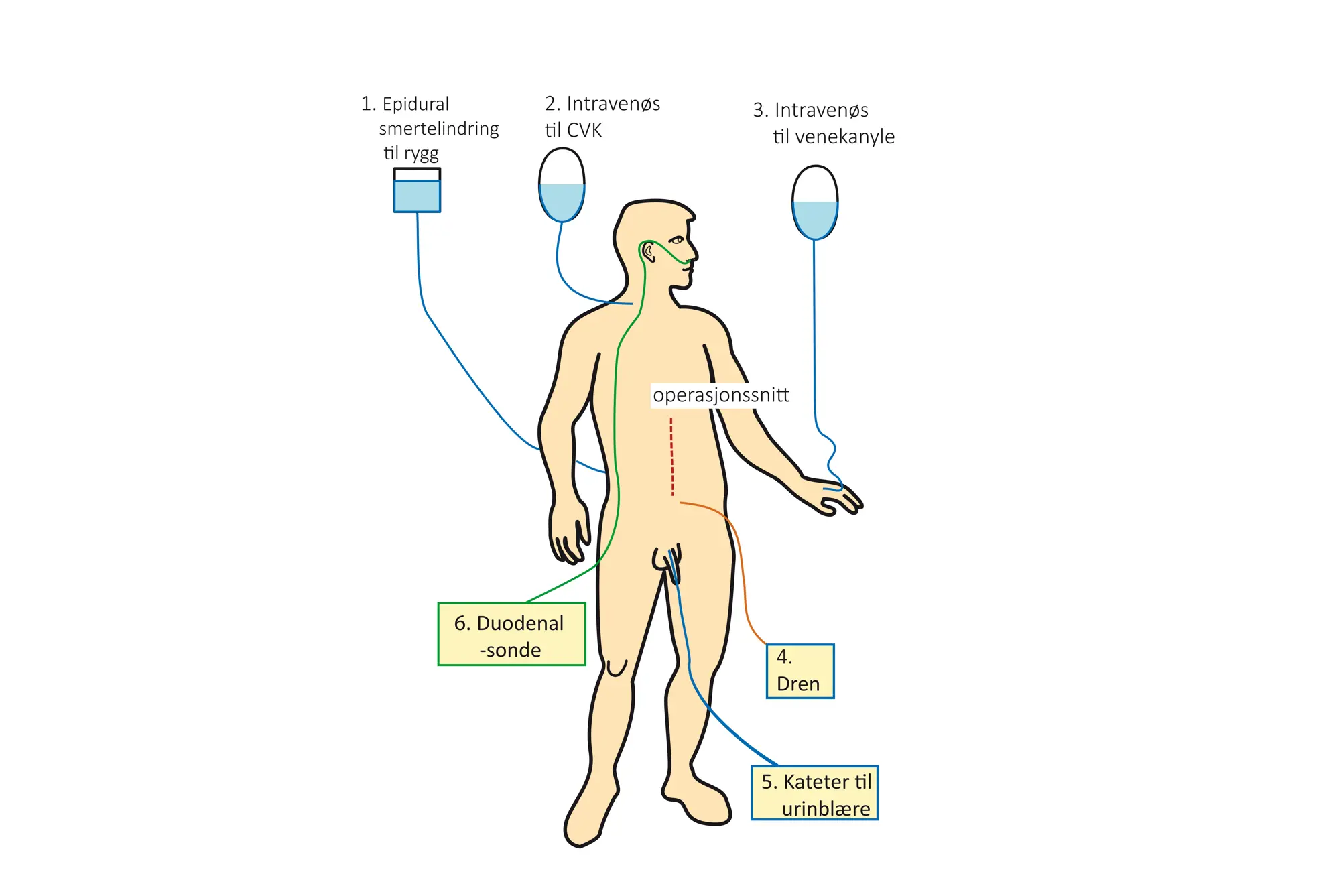 mann med slanger og kateter