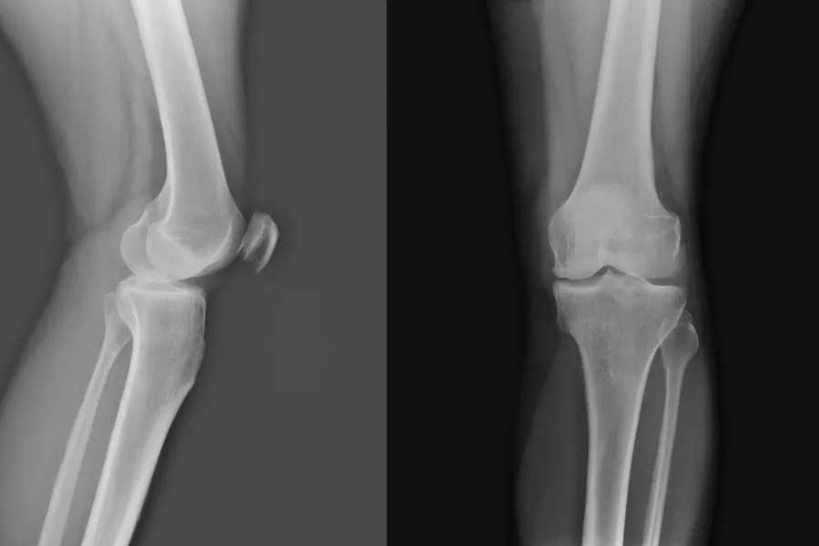 Et røntgen av en kvinnes ben